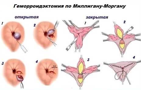 Миллигана