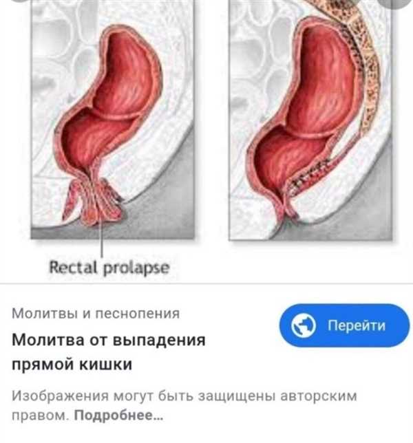 Выпадение прямой кишки презентация