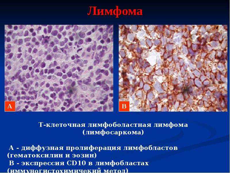 Диффузная в клеточная лимфома клинические рекомендации. Лимфосаркома патанатомия. Крупноклеточная лимфома гистология. Нодулярная лимфосаркома.