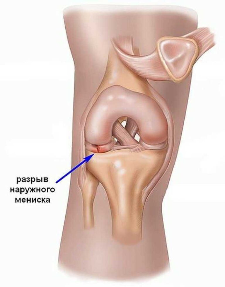 Разрыв мениска что это такое. Разрыв мениска в колене симптомы. Травма мениска коленного сустава симптомы. Повреждение мениска коленного сустава симптомы. Разрыв наружного мениска коленного сустава симптомы.