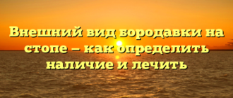 Внешний вид бородавки на стопе — как определить наличие и лечить